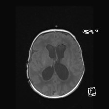 File:Atypical teratoid rhabdoid tumor (prenatal US and neonatal MRI) (Radiopaedia 59091-66388 Axial T1 36).jpg