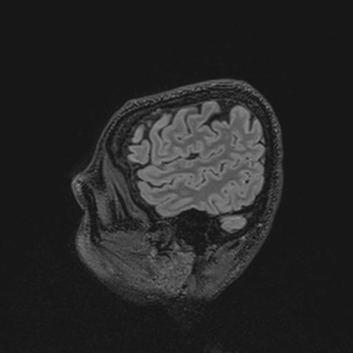 Autoimmune limbic encephalitis (Radiopaedia 30363-31005 Sagittal FLAIR 130).jpg