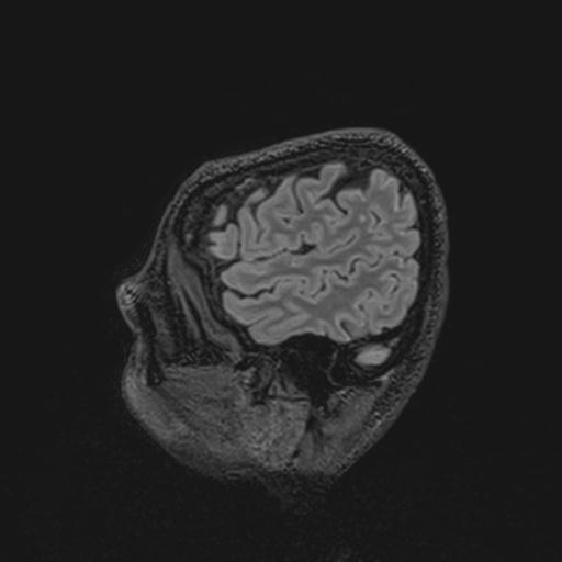 Autoimmune limbic encephalitis (Radiopaedia 30363-31005 Sagittal FLAIR 131).jpg