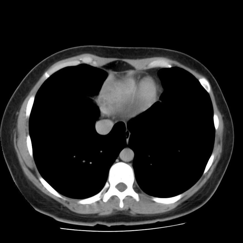 Autosomal dominant polycystic kidney disease (Radiopaedia 23061-23093 C+ delayed 4).jpg