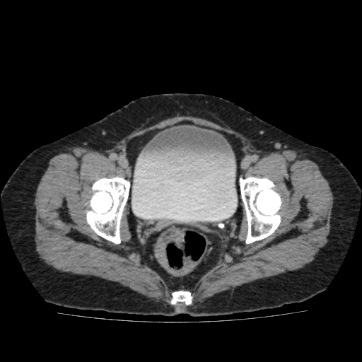 Autosomal dominant polycystic kidney disease (Radiopaedia 38189-40194 Axial C+ delayed 54).jpg