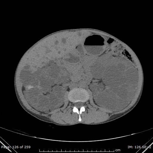 File:Autosomal dominant polycystic kidney disease (Radiopaedia 44122-47684 Axial 5).jpg
