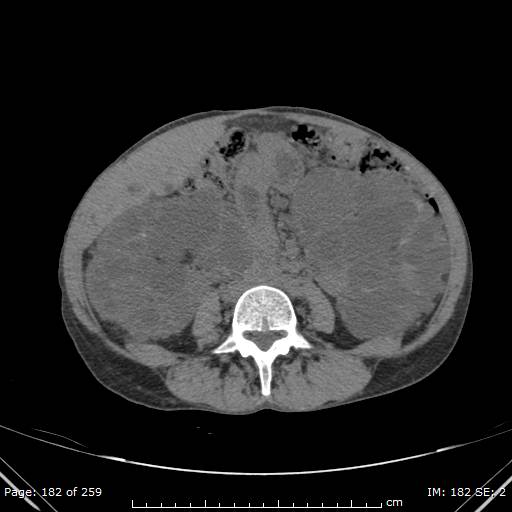 File:Autosomal dominant polycystic kidney disease (Radiopaedia 44122-47684 Axial non-contrast 65).jpg