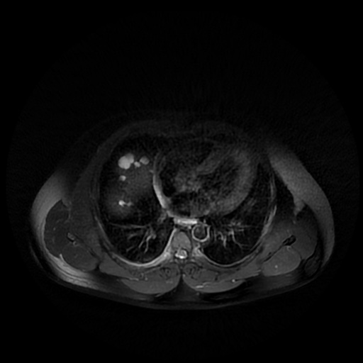 File:Autosomal dominant polycystic kidney disease (Radiopaedia 50259-55611 Axial T2 fat sat 1).jpg