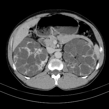 Autosomal dominant polycystic kidney disease (Radiopaedia 66349-75582 B 33).jpg