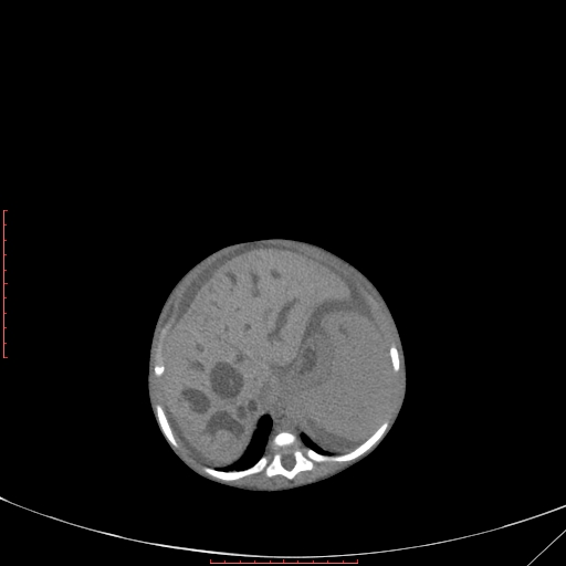 Autosomal recessive polycystic kidney disease associated with Caroli disease (Radiopaedia 61932-69984 B 122).jpg