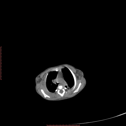 Autosomal recessive polycystic kidney disease associated with Caroli disease (Radiopaedia 61932-69984 B 28).jpg