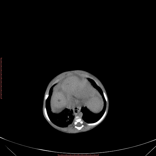File:Autosomal recessive polycystic kidney disease associated with Caroli disease (Radiopaedia 61932-69984 B 99).jpg