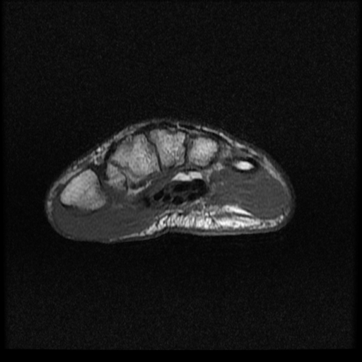 File:Avascular necrosis - scaphoid non-union (Radiopaedia 63457-72065 Axial T1 2).jpg