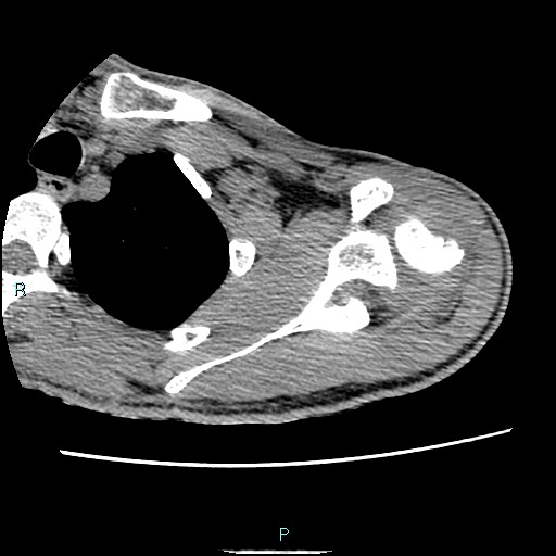 Avascular necrosis after fracture dislocations of the proximal humerus (Radiopaedia 88078-104653 D 29).jpg
