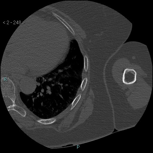 Avascular necrosis of the shoulder - Cruess stage I (Radiopaedia 77674-89887 Axial bone window 62).jpg
