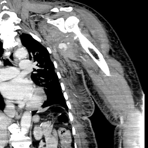 File:Axillary arterial pseudoaneurysm (Radiopaedia 24925-25195 B 8).jpg