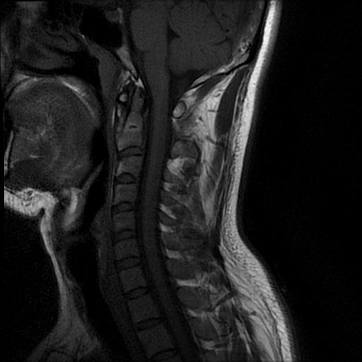 File:Axis fracture - MRI (Radiopaedia 71925-82375 Sagittal T1 5).jpg