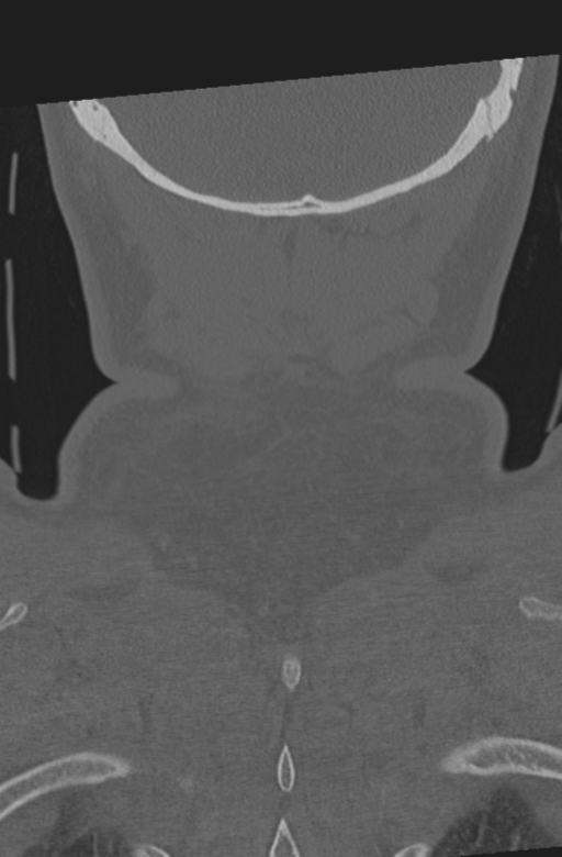 Axis peg fracture (type 3) and atlas lateral mass (type 4) fracture (Radiopaedia 37474-39324 Coronal bone window 62).png