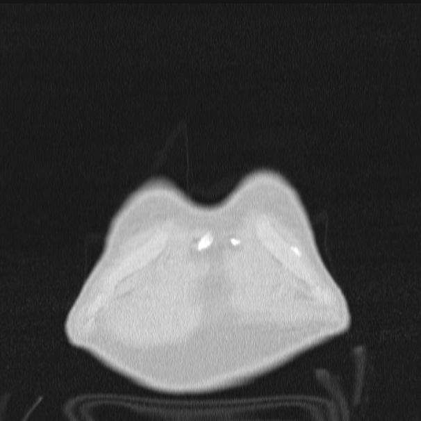 Azygos lobe (Radiopaedia 38259-40275 Coronal lung window 4).jpg