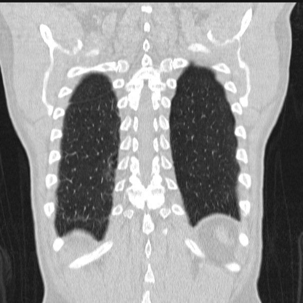 Azygos lobe (Radiopaedia 38259-40275 Coronal lung window 67).jpg