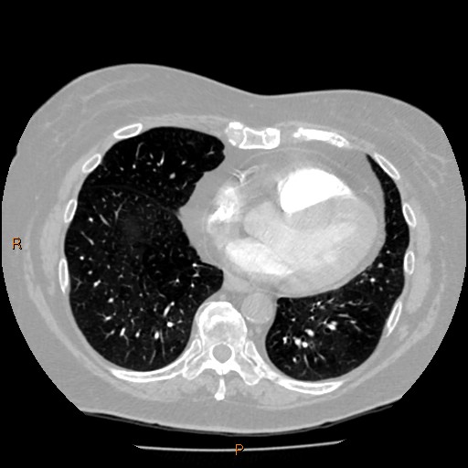 Azygos lobe (Radiopaedia 40161-42821 Axial lung window 50).jpg