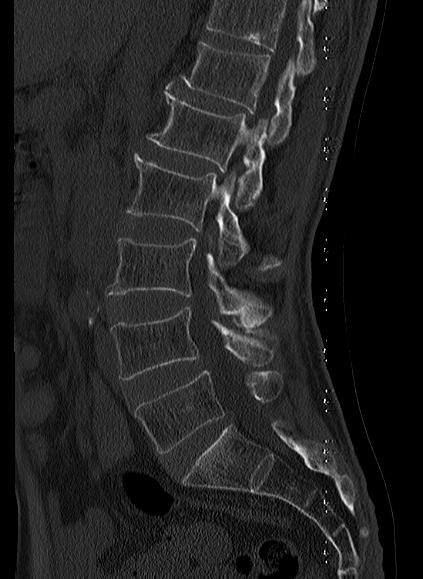 File:Baastrup syndrome (Radiopaedia 64891-73838 Sagittal bone window 8).jpg