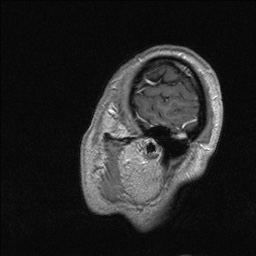 Balo concentric sclerosis (Radiopaedia 50458-55940 Sagittal T1 C+ 138).jpg
