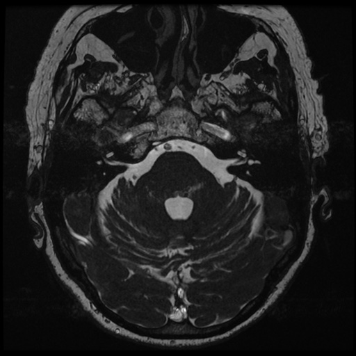 File:Balo concentric sclerosis (Radiopaedia 53875-59982 Axial T2 FIESTA 41).jpg