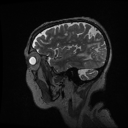 Balo concentric sclerosis (Radiopaedia 53875-59982 Sagittal 3D FSE 60).jpg