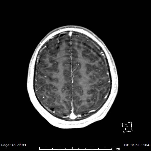 File:Balo concentric sclerosis (Radiopaedia 61637-69636 Axial T1 C+ 65).jpg