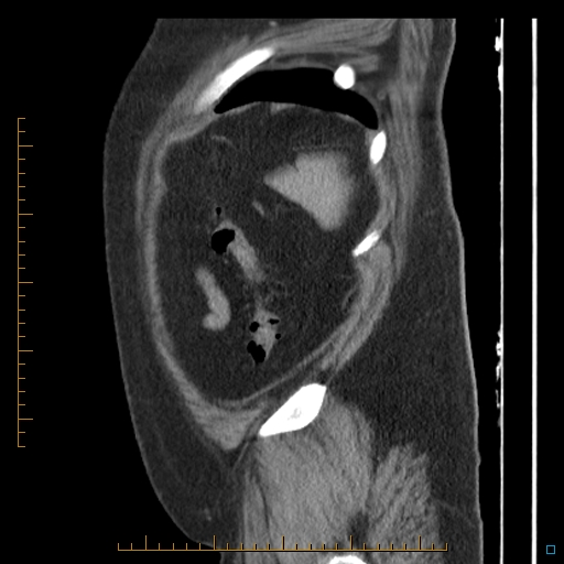 File:Bariatric balloon causing gastric outlet obstruction (Radiopaedia 54449-60672 C 9).jpg