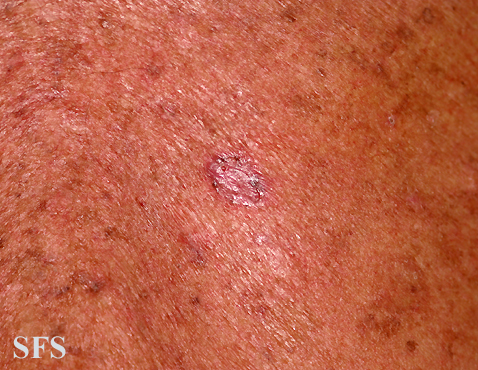 Basal Cell Carcinoma (Dermatology Atlas 172).jpg