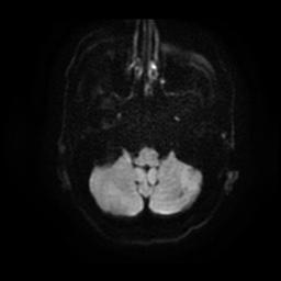 File:Basal cell carcinoma (periorbital) (Radiopaedia 55179-61559 Axial DWI 5).jpg
