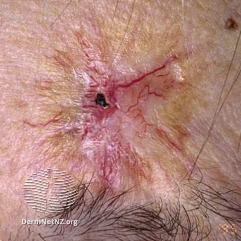 File:Basal cell carcinoma affecting the face (DermNet NZ lesions-bcc-face-0616).jpg