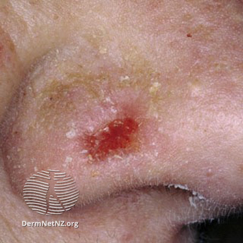 File:Basal cell carcinoma affecting the nose (DermNet NZ lesions-bcc-nose-0637).jpg