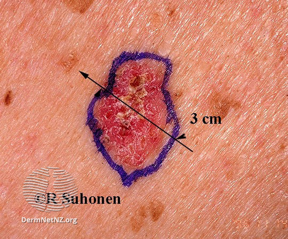 File:Basal cell carcinoma affecting the trunk (DermNet NZ lesions-bcc-trunk-0641).jpg