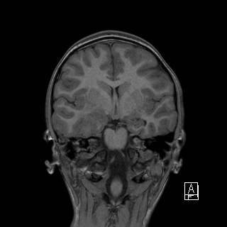 Base of skull rhabdomyosarcoma (Radiopaedia 32196-33142 Coronal T1 23).jpg