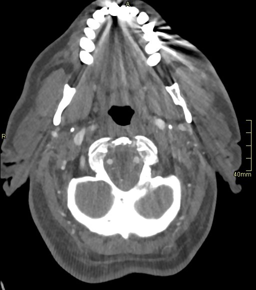 File:Basilar artery aneurysm (Radiopaedia 56261-62932 A 33).jpg