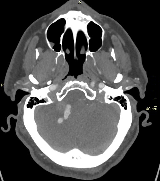 Basilar artery aneurysm (Radiopaedia 56261-62932 A 46).jpg