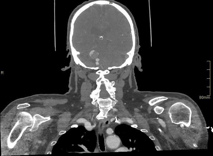 Basilar artery aneurysm (Radiopaedia 56261-62932 B 42).jpg