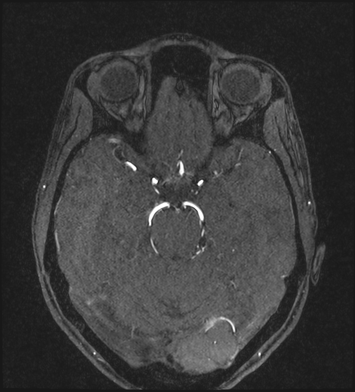 Basilar artery perforator aneurysm (Radiopaedia 82455-97733 Axial MRA 97).jpg