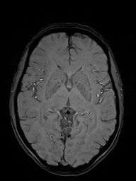 Basilar artery perforator aneurysm (Radiopaedia 82455-97733 Axial SWI 28).jpg