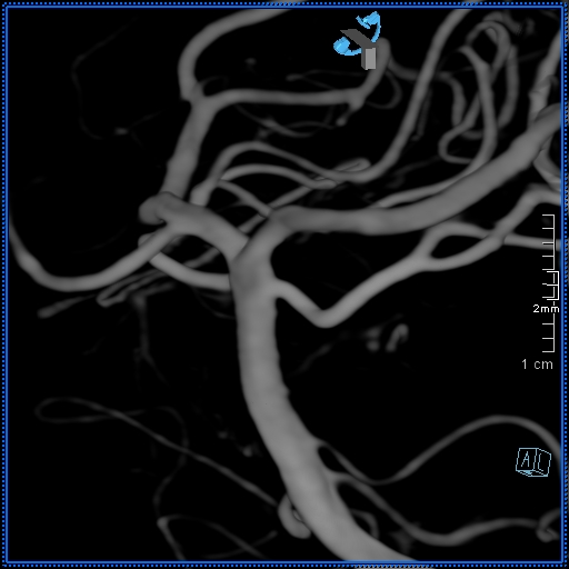 Basilar artery perforator aneurysm (Radiopaedia 82455-99524 3D Left VA 33).jpg