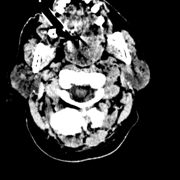 File:Basilar artery thrombosis (Radiopaedia 53351-59333 Axial non-contrast 12).jpg