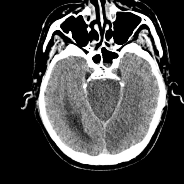 Basilar artery thrombosis (Radiopaedia 53351-59352 Axial non-contrast 45).jpg