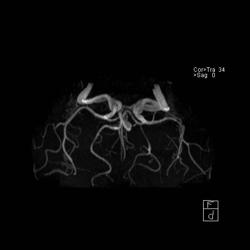 Basilar tip aneurysm (Radiopaedia 26504-26632 D 12).jpg