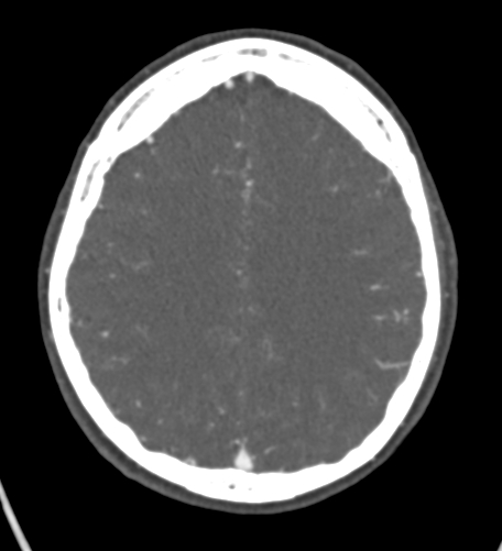 Basilar tip aneurysm with coiling (Radiopaedia 53912-60086 A 106).jpg
