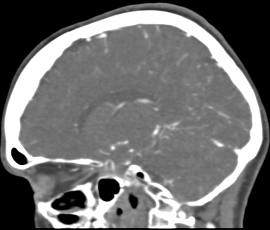 Basilar tip aneurysm with coiling (Radiopaedia 53912-60086 C 80).jpg