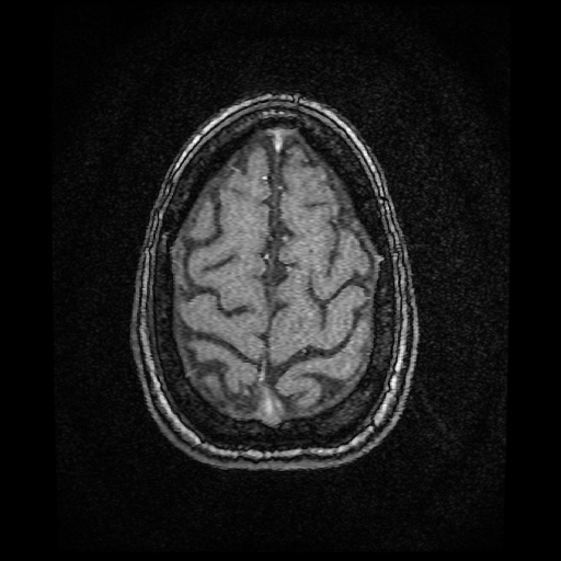 Basilar top and left middle cerebral artery aneurysm (Radiopaedia 61965-70031 Axial MRA 154).jpg