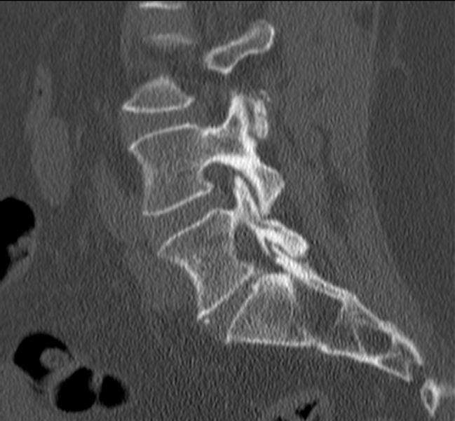 Bertolotti syndrome (Radiopaedia 24864-25128 Sagittal bone window 36).jpg