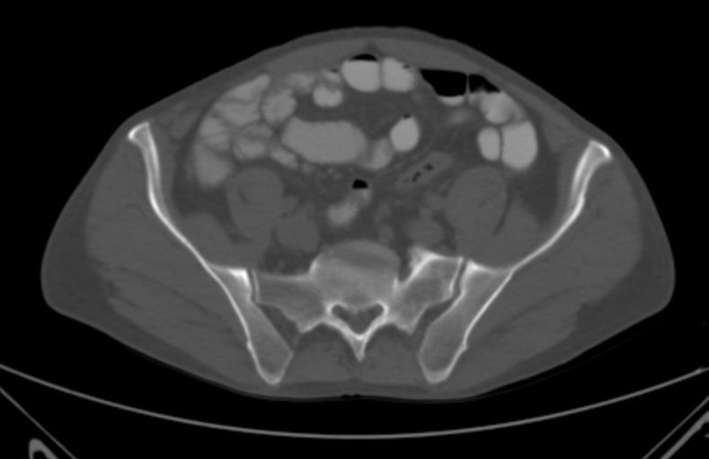 File:Bertolotti syndrome (Radiopaedia 58974-66235 Axial bone window 6).jpg