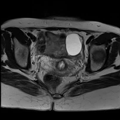 File:Bicornuate uterus (MRI) (Radiopaedia 49206-54297 Axial 28).png