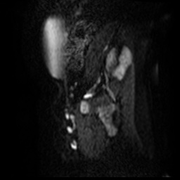 File:Bicornuate uterus (Radiopaedia 51676-57472 Sagittal DWI 5).jpg