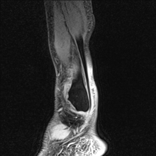 Bilateral Achilles tendon complete tear (Radiopaedia 81344-95051 Sagittal WE - Left 98).jpg